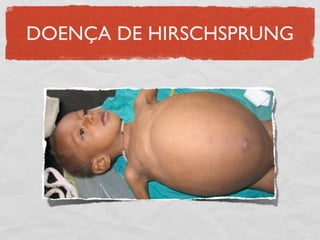 DOENÇA DE HIRSCHSPRUNG
 