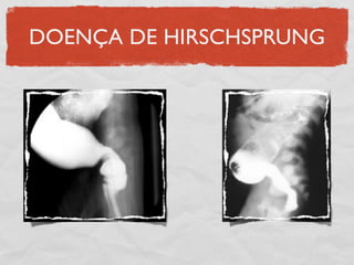 DOENÇA DE HIRSCHSPRUNG
 