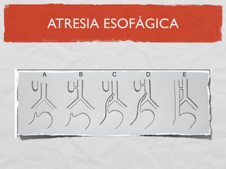 ATRESIA ESOFÁGICA
 