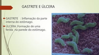 GASTRITE E ÚLCERA
GASTRITE : Inflamação da parte
interna do estômago.
ÚLCERA: Formação de uma
ferida na parede do estômago.
 