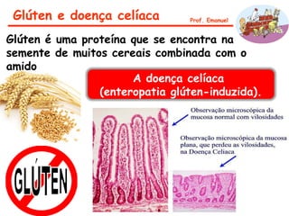 Glúten e doença celíaca Prof. Emanuel
Glúten é uma proteína que se encontra na
semente de muitos cereais combinada com o
amido
A doença celíaca
(enteropatia glúten-induzida).
 