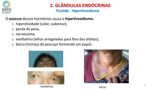 O excesso desses hormônios causa o hipertireoidismo:
o hiperatividade (calor, sudorese),
o perda de peso,
o nervosismo,
o exoftalmia (olhos arregalados para fora das órbitas),
o bócio (inchaço do pescoço formando um papo).
CIÊNCIAS, 8º Ano do Ensino Fundamental
Glândulas e suas funções
CIÊNCIAS, 8º Ano do Ensino Fundamental
Glândulas e suas funções
CIÊNCIAS, 8º Ano do Ensino Fundamental
Glândulas e suas funções
CIÊNCIAS, 8º Ano do Ensino Fundamental
Glândulas e suas funções
CIÊNCIAS, 8º Ano do Ensino Fundamental
Glândulas e suas funções
CIÊNCIAS, 8º Ano do Ensino Fundamental
Glândulas e suas funções
CIÊNCIAS, 8º Ano do Ensino Fundamental
Glândulas e suas funções
2. GLÂNDULAS ENDÓCRINAS
Tireóide - Hipertireoidismo
exoftalmia bócio
24
 