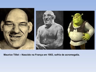 Maurice Tillet – Nascido na França em 1903, sofria de acromegalia.
 