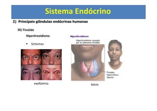 Sistema Endócrino
2) Principais glândulas endócrinas humanas
III) Tireóide
Hipertireoidismo
Sintomas
exoftalmia bócio
 