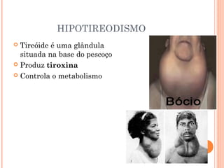HIPOTIREODISMO
 Tireóide é uma glândula
situada na base do pescoço
 Produz tiroxina
 Controla o metabolismo
 