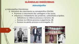 a) Adenoipófise (Hormônios)
I) Hormônio do crescimento ou somatotrófico (GH/SH)
 Promove o crescimento das cartilagens e dos ossos;
 influencia o metabolismo das proteínas, carboidratos e lipídios.
o Deficiência na infância provoca o nanismo. (A)
o Excesso na infância provoca o gigantismo. (B)
o Excesso no adulto provoca a acromegalia. (C)
A B C
GLÂNDULAS ENDÓCRINAS
Adenohipófise
16
 