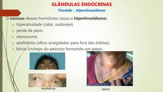 O excesso desses hormônios causa o hipertireoidismo:
o hiperatividade (calor, sudorese),
o perda de peso,
o nervosismo,
o exoftalmia (olhos arregalados para fora das órbitas),
o bócio (inchaço do pescoço formando um papo).
GLÂNDULAS ENDÓCRINAS
Tireóide - Hipertireoidismo
exoftalmia bócio
 
