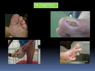 PÉ DIABÉTICO
 