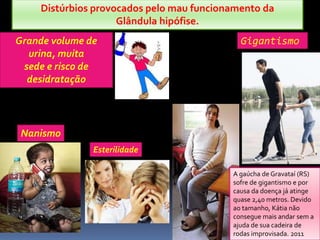 Distúrbios provocados pelo mau funcionamento da
Glândula hipófise.
Grande volume de
urina, muita
sede e risco de
desidratação
Esterilidade
Nanismo
Gigantismo
A gaúcha de Gravataí (RS)
sofre de gigantismo e por
causa da doença já atinge
quase 2,40 metros. Devido
ao tamanho, Kátia não
consegue mais andar sem a
ajuda de sua cadeira de
rodas improvisada. 2011
 