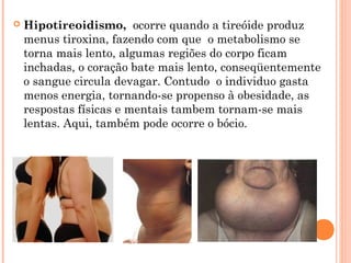    Hipotireoidismo, ocorre quando a tireóide produz
    menus tiroxina, fazendo com que o metabolismo se
    torna mais lento, algumas regiões do corpo ficam
    inchadas, o coração bate mais lento, conseqüentemente
    o sangue circula devagar. Contudo o individuo gasta
    menos energia, tornando-se propenso à obesidade, as
    respostas físicas e mentais tambem tornam-se mais
    lentas. Aqui, também pode ocorre o bócio.
 