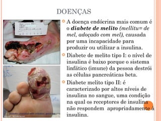 DOENÇAS
  A doença endócrina mais comum é
   o diabete de melito (mellitu= de
   mel, adoçado com mel), causada
   por uma incapacidade para
   produzir ou utilizar a insulina.
  Diabete de melito tipo I: o nível de
   insulina é baixo porque o sistema
   linfático (imune) da pessoa destrói
   as células pancreáticas beta.
  Diabete melito tipo II: é
   caracterizado por altos níveis de
   insulina no sangue, uma condição
   na qual os receptores de insulina
   não respondem apropriadamente à
   insulina.
 