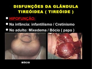 DISFUNÇÕES DA GLÂNDULA
TIREÓIDEA ( TIREÓIDE )
HIPOFUNÇÃO:
Na infância: infantilismo / Cretinismo
No adulto: Mixedema / Bócio ( papo )
BÓCIO
 