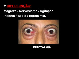 HIPERFUNÇÃO:
Magreza / Nervosismo / Agitação
Insônia / Bócio / Exoftalmia.
EXOFTALMIA
 