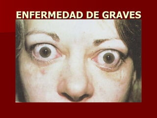 ENFERMEDAD DE GRAVES 
