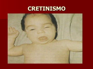 CRETINISMO 