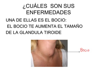 ¿CUÁLES  SON SUS ENFERMEDADES UNA DE ELLAS ES EL BOCIO: EL BOCIO TE AUMENTA EL TAMAÑO  DE LA GLANDULA TIROIDE 