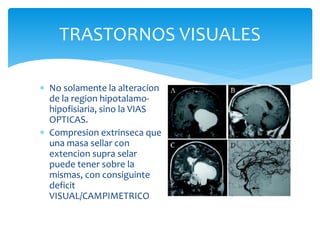 TRASTORNOS VISUALES
 No solamente la alteracion
de la region hipotalamo-
hipofisiaria, sino la VIAS
OPTICAS.
 Compresion extrinseca que
una masa sellar con
extencion supra selar
puede tener sobre la
mismas, con consiguinte
deficit
VISUAL/CAMPIMETRICO
 