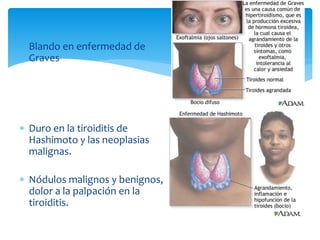  Blando en enfermedad de
Graves
 Duro en la tiroiditis de
Hashimoto y las neoplasias
malignas.
 Nódulos malignos y benignos,
dolor a la palpación en la
tiroiditis.
 