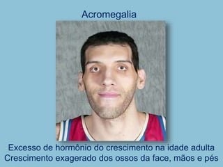 Acromegalia
Excesso de hormônio do crescimento na idade adulta
Crescimento exagerado dos ossos da face, mãos e pés
 