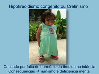 Causado por falta de hormônio da tireoide na infância
Consequências  nanismo e deficiência mental
Hipotireoidismo congênito ou Cretinismo
 