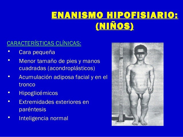 enanismo hipofisiario