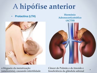A hipófise anterior
• Prolactina (LTH)
Hormônio
Adrenocorticotrófico
(ACTH)
o bloqueio da menstruação
(amenorreia), causando infertilidade
Câncer de Pulmão e de tireoide e
Insuficiência da glândula adrenal
 
