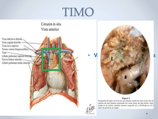 TIMO
• LOCALIZAÇÃO
• Vascularização : troncos
braquiocefálicos
 