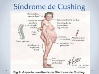 Síndrome de Cushing
 