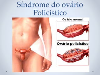 Síndrome do ovário
Policístico
 