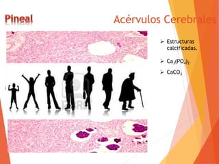 Acérvulos Cerebrales
 Estructuras
calcificadas.
 Ca3(PO4)2
 CaCO3
 