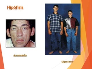 Gigantismo
Acromegalia
 