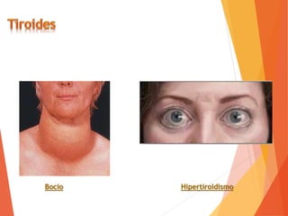 Bocio Hipertiroidismo
 