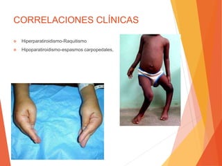 CORRELACIONES CLÍNICAS
 Hiperparatiroidismo-Raquitismo
 Hipoparatiroidismo-espasmos carpopedales,
 