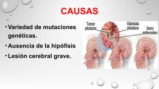 CAUSAS
•Variedad de mutaciones
genéticas.
•Ausencia de la hipófisis
•Lesión cerebral grave.
 