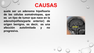 CAUSAS
suele ser un adenoma hipofisario
de las células somatrotopas, que
es un tipo de tumor que nace en la
adenohipófisis(parte anterior) de
origen benigno, es decir, es una
afección autolimitada y no
progresiva.
 