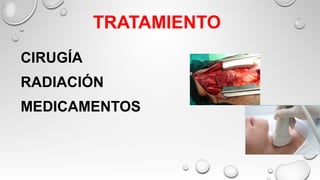 TRATAMIENTO
CIRUGÍA
RADIACIÓN
MEDICAMENTOS
 