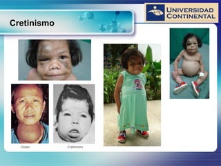 Cretinismo
 