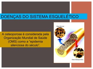 A osteoporose é considerada pela
Organização Mundial de Saúde
(OMS) como a “epidemia
silenciosa do século”.
DOENÇAS DO SISTEMA ESQUELÉTICO
 