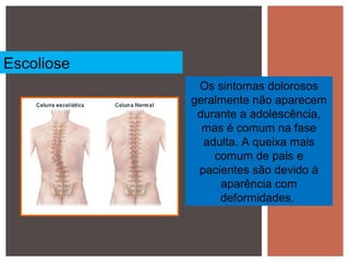 Os sintomas dolorosos
geralmente não aparecem
durante a adolescência,
mas é comum na fase
adulta. A queixa mais
comum de pais e
pacientes são devido à
aparência com
deformidades.
Escoliose
 