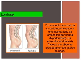 É o aumento anormal da
curva lombar levando a
uma acentuação da
lordose lombar normal
(hiperlordose). Os
músculos abdominais
fracos e um abdome
protuberante são fatores
de risco.
Lordose
 