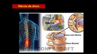 Hérnia de disco
 