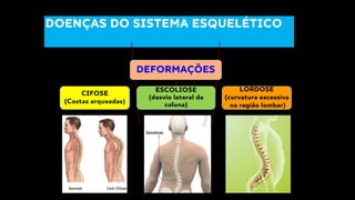 DOENÇAS DO SISTEMA ESQUELÉTICO
DEFORMAÇÕES
CIFOSE
(Costas arqueadas)
ESCOLIOSE
(desvio lateral da
coluna)
LORDOSE
(curvatura excessiva
na região lombar)
 