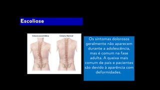 Os sintomas dolorosos
geralmente não aparecem
durante a adolescência,
mas é comum na fase
adulta. A queixa mais
comum de pais e pacientes
são devido à aparência com
deformidades.
Escoliose
 