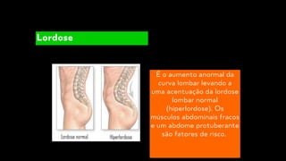 É o aumento anormal da
curva lombar levando a
uma acentuação da lordose
lombar normal
(hiperlordose). Os
músculos abdominais fracos
e um abdome protuberante
são fatores de risco.
Lordose
 