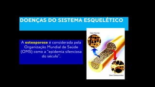 A osteoporose é considerada pela
Organização Mundial de Saúde
(OMS) como a “epidemia silenciosa
do século”.
DOENÇAS DO SISTEMA ESQUELÉTICO
 