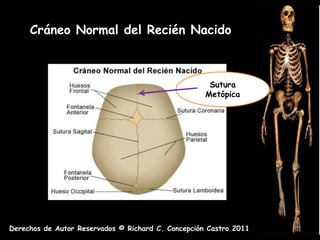 Cráneo Normal del Recién Nacido



                                                     Sutura
                                                    Metópica




Derechos de Autor Reservados © Richard C. Concepción Castro 2011
 