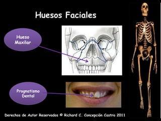 Huesos Faciales

     Hueso
     Maxilar




      Prognatismo
         Dental



Derechos de Autor Reservados © Richard C. Concepción Castro 2011
 