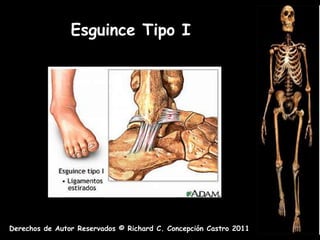 Esguince Tipo I




Derechos de Autor Reservados © Richard C. Concepción Castro 2011
 