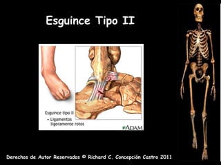 Esguince Tipo II




Derechos de Autor Reservados © Richard C. Concepción Castro 2011
 