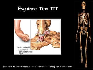 Esguince Tipo III




Derechos de Autor Reservados © Richard C. Concepción Castro 2011
 